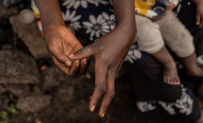 Mpox: Sem capacidade de testar Guiné-Bissau prepara plano de contingência