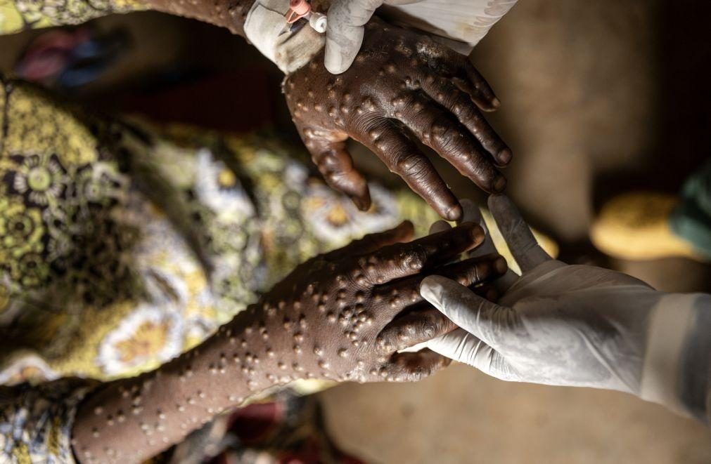 Infecciologista afasta hipótese de epidemia de Mpox em Portugal